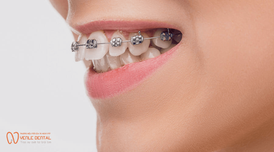 niềng răng 1 hàm mất bao lâu